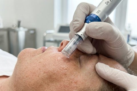 PRP & Microneedling